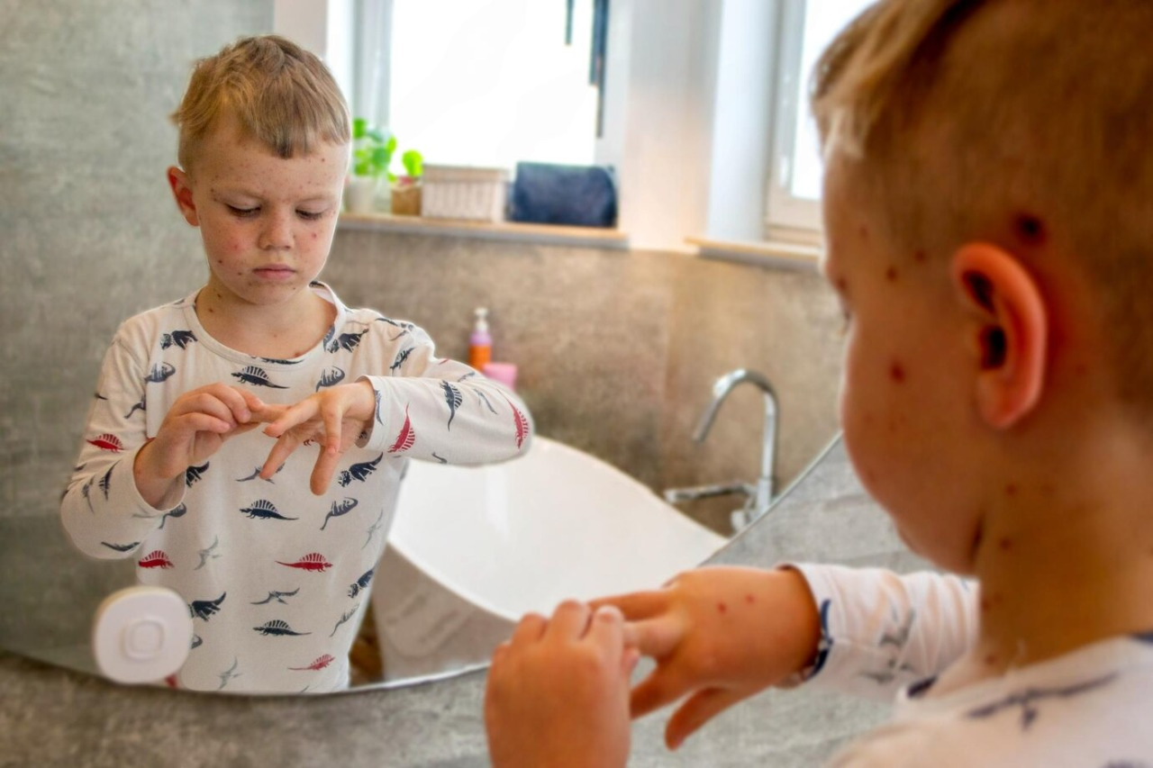 What Causes Warts on Kids